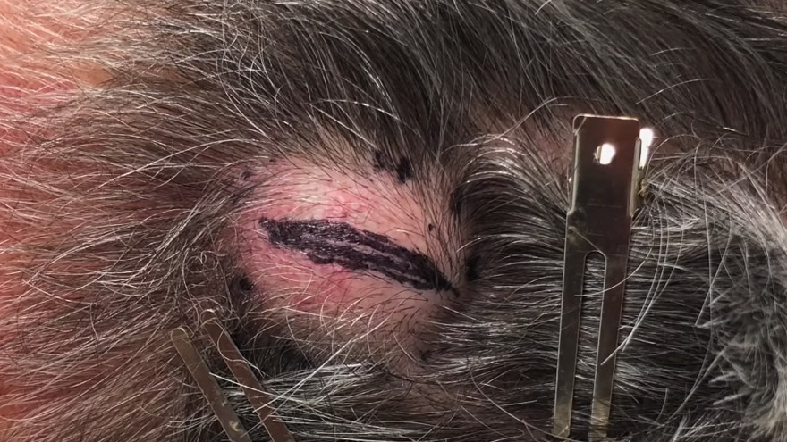Watch Dr. Pimple Popper take on a horrific cyst that looks like an egg