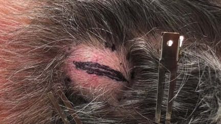 Watch Dr. Pimple Popper take on a horrific cyst that looks like an egg